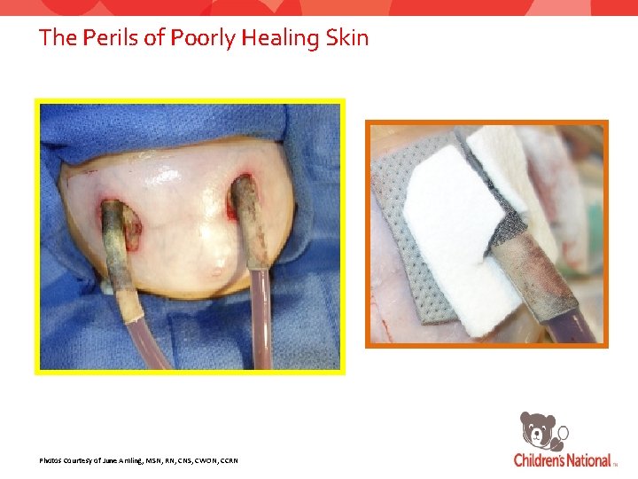 The Perils of Poorly Healing Skin Photos Courtesy of June Amling, MSN, RN, CNS,