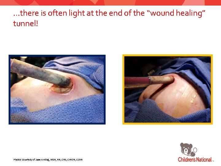 …there is often light at the end of the “wound healing” tunnel! Photos Courtesy