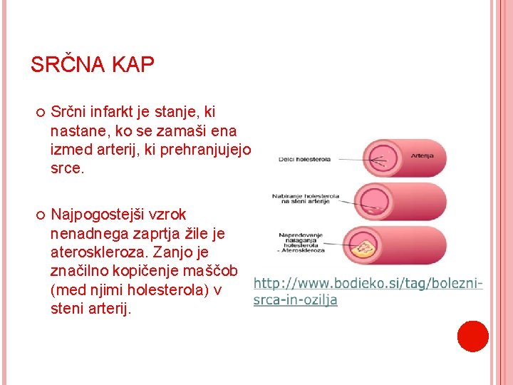 SRČNA KAP Srčni infarkt je stanje, ki nastane, ko se zamaši ena izmed arterij,