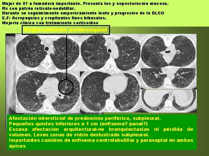 Mujer de 57 a fumadora importante. Presenta tos y expectoración mucosa. Rx con patrón Mujer de 57 a fumadora importante. Presenta tos y expectoración mucosa. Rx con patrón