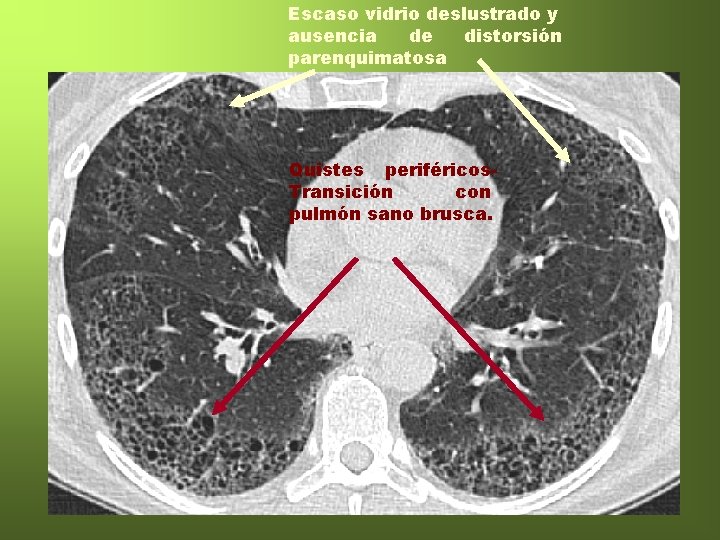 Escaso vidrio deslustrado y ausencia de distorsión parenquimatosa Quistes periféricos. Transición con pulmón sano