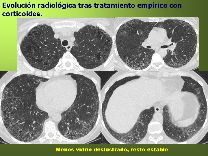 Evolución radiológica tras tratamiento empírico con corticoides. Menos vidrio deslustrado, resto estable 