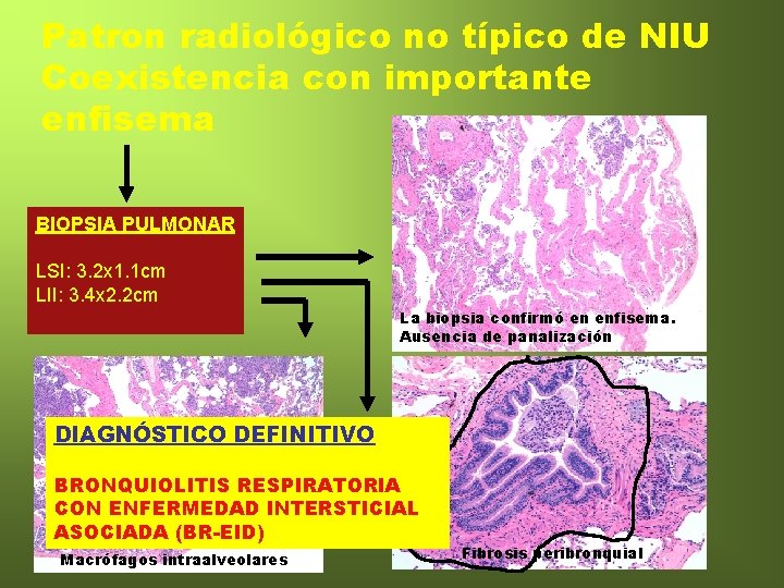 Patron radiológico no típico de NIU Coexistencia con importante enfisema BIOPSIA PULMONAR LSI: 3.