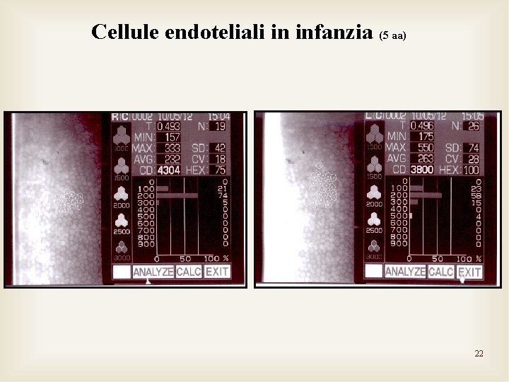 Cellule endoteliali in infanzia (5 aa) 22 