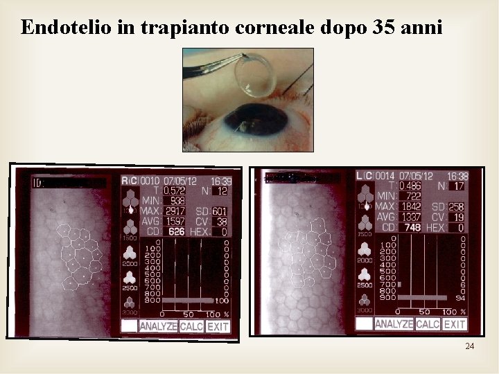 Endotelio in trapianto corneale dopo 35 anni 24 