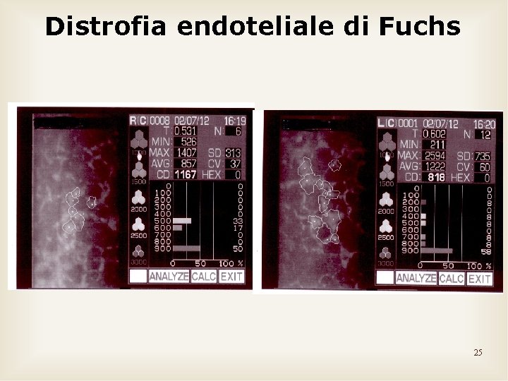 Distrofia endoteliale di Fuchs 25 