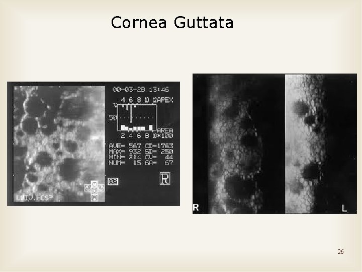 Cornea Guttata 26 