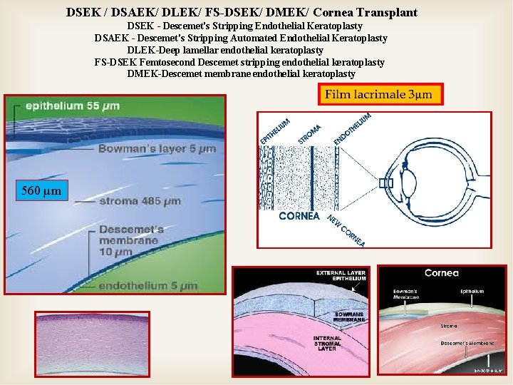 DSEK / DSAEK/ DLEK/ FS-DSEK/ DMEK/ Cornea Transplant DSEK - Descemet's Stripping Endothelial Keratoplasty