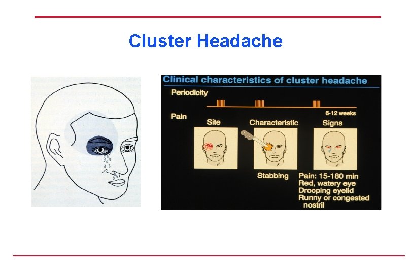 Cluster Headache 