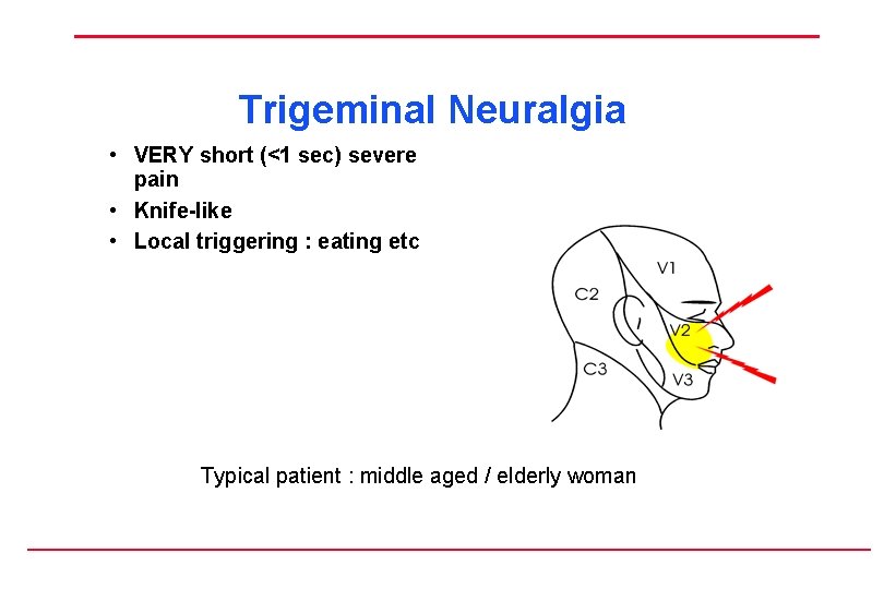 Trigeminal Neuralgia • VERY short (<1 sec) severe pain • Knife-like • Local triggering