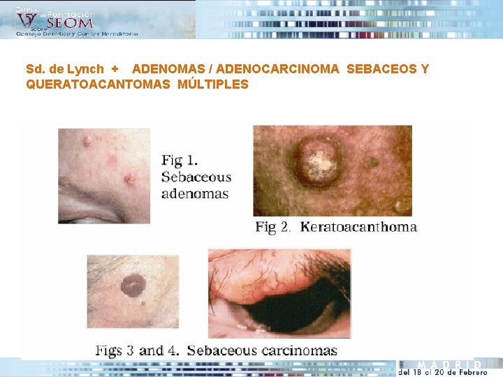 Sd. de Lynch + ADENOMAS / ADENOCARCINOMA SEBACEOS Y QUERATOACANTOMAS MÚLTIPLES 