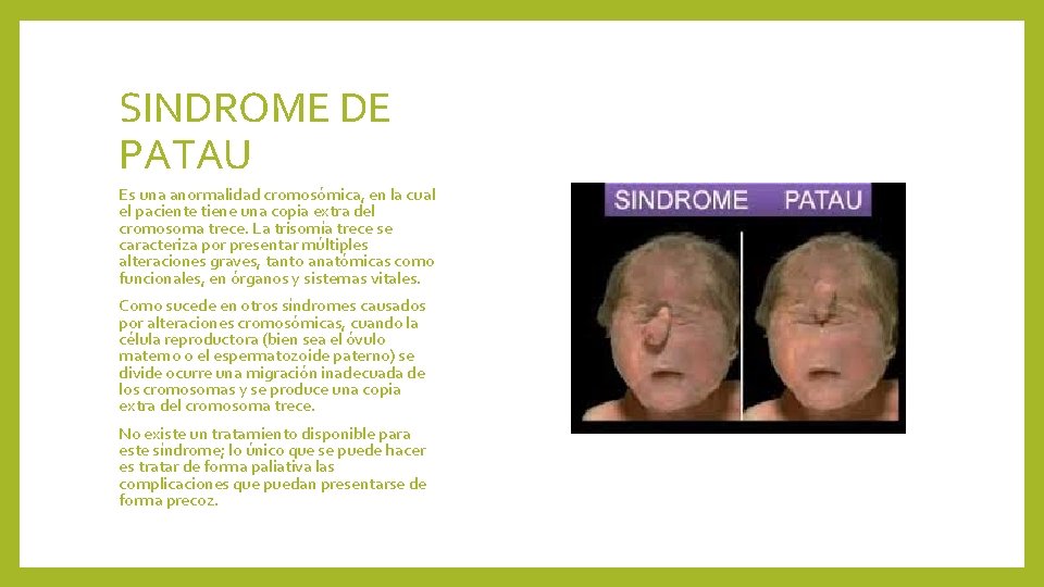 SINDROME DE PATAU Es una anormalidad cromosómica, en la cual el paciente tiene una