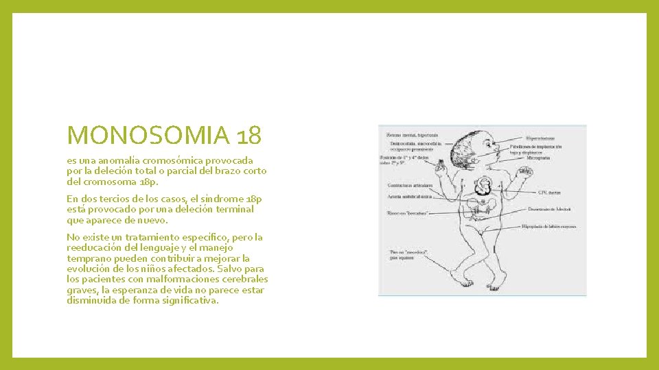 MONOSOMIA 18 es una anomalía cromosómica provocada por la deleción total o parcial del