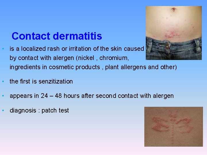 Contact dermatitis • is a localized rash or irritation of the skin caused by