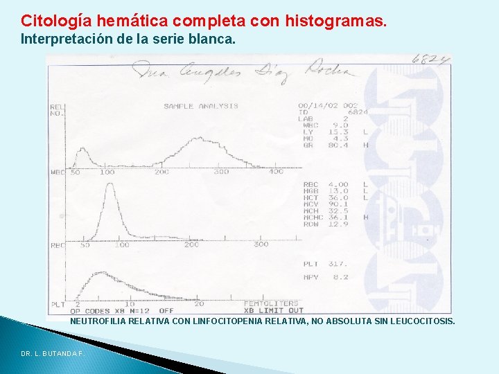 Citología hemática completa con histogramas. Interpretación de la serie blanca. NEUTROFILIA RELATIVA CON LINFOCITOPENIA Citología hemática completa con histogramas. Interpretación de la serie blanca. NEUTROFILIA RELATIVA CON LINFOCITOPENIA