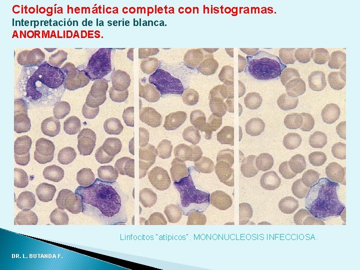 Citología hemática completa con histogramas. Interpretación de la serie blanca. ANORMALIDADES. Linfocitos “atípicos”. MONONUCLEOSIS Citología hemática completa con histogramas. Interpretación de la serie blanca. ANORMALIDADES. Linfocitos “atípicos”. MONONUCLEOSIS