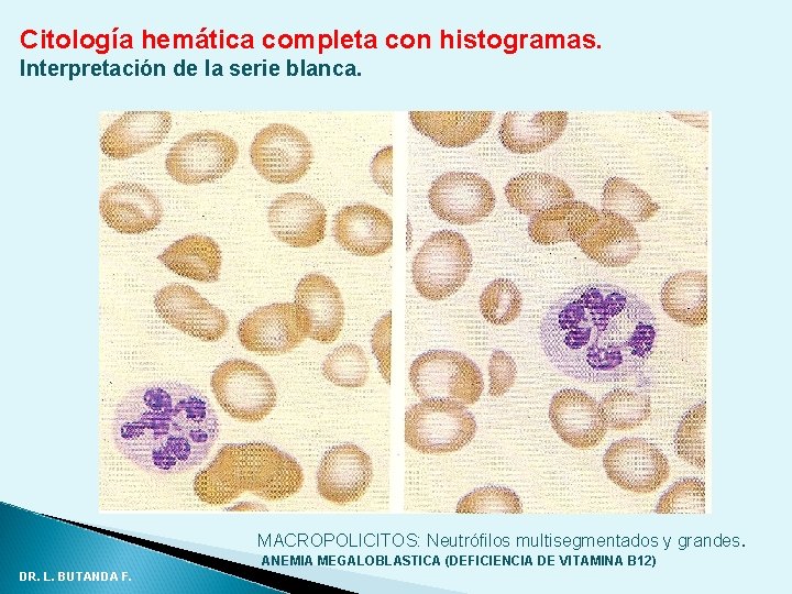 Citología hemática completa con histogramas. Interpretación de la serie blanca. MACROPOLICITOS: Neutrófilos multisegmentados y Citología hemática completa con histogramas. Interpretación de la serie blanca. MACROPOLICITOS: Neutrófilos multisegmentados y
