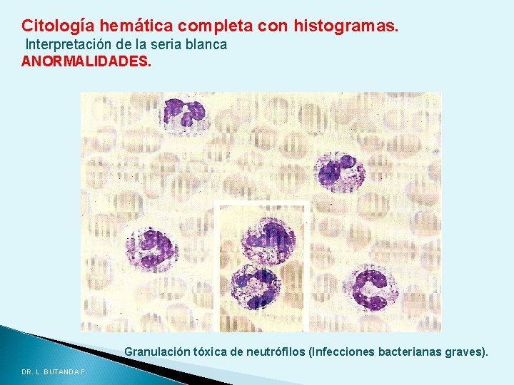 Citología hemática completa con histogramas. Interpretación de la seria blanca ANORMALIDADES. Granulación tóxica de Citología hemática completa con histogramas. Interpretación de la seria blanca ANORMALIDADES. Granulación tóxica de
