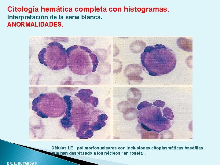 Citología hemática completa con histogramas. Interpretación de la serie blanca. ANORMALIDADES. Células LE: polimorfonucleares Citología hemática completa con histogramas. Interpretación de la serie blanca. ANORMALIDADES. Células LE: polimorfonucleares