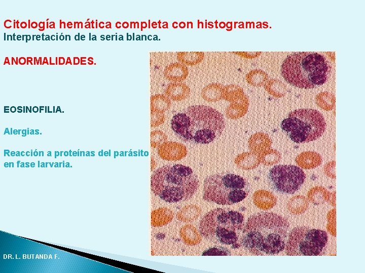 Citología hemática completa con histogramas. Interpretación de la seria blanca. ANORMALIDADES. EOSINOFILIA. Alergias. Reacción Citología hemática completa con histogramas. Interpretación de la seria blanca. ANORMALIDADES. EOSINOFILIA. Alergias. Reacción