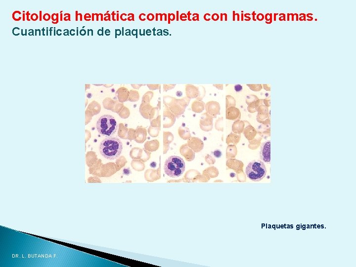 Citología hemática completa con histogramas. Cuantificación de plaquetas. Plaquetas gigantes. DR. L. BUTANDA F. Citología hemática completa con histogramas. Cuantificación de plaquetas. Plaquetas gigantes. DR. L. BUTANDA F.