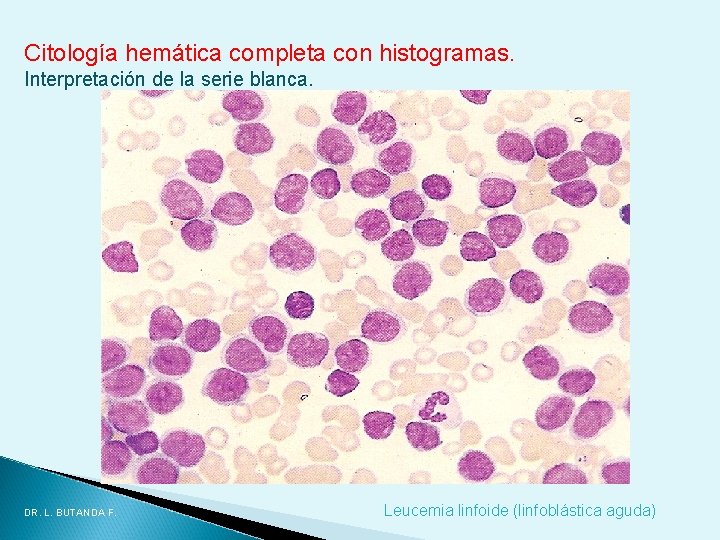 Citología hemática completa con histogramas. Interpretación de la serie blanca. DR. L. BUTANDA F. Citología hemática completa con histogramas. Interpretación de la serie blanca. DR. L. BUTANDA F.