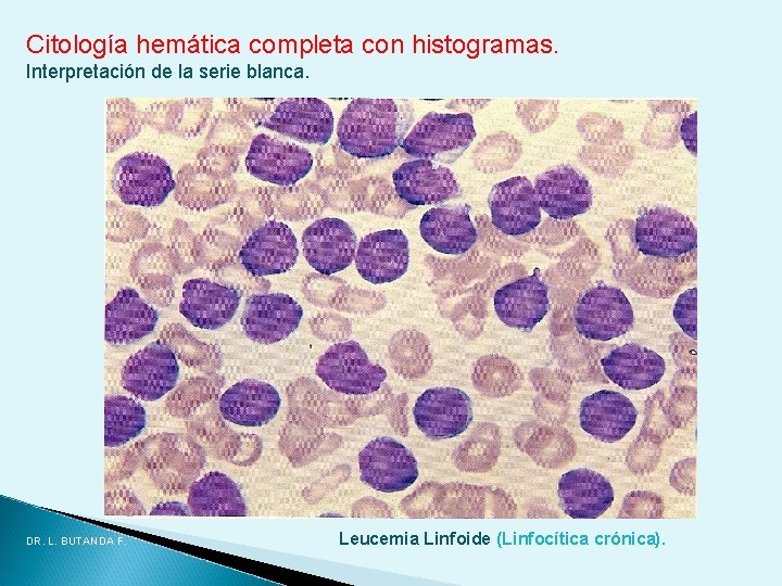 Citología hemática completa con histogramas. Interpretación de la serie blanca. DR. L. BUTANDA F. Citología hemática completa con histogramas. Interpretación de la serie blanca. DR. L. BUTANDA F.