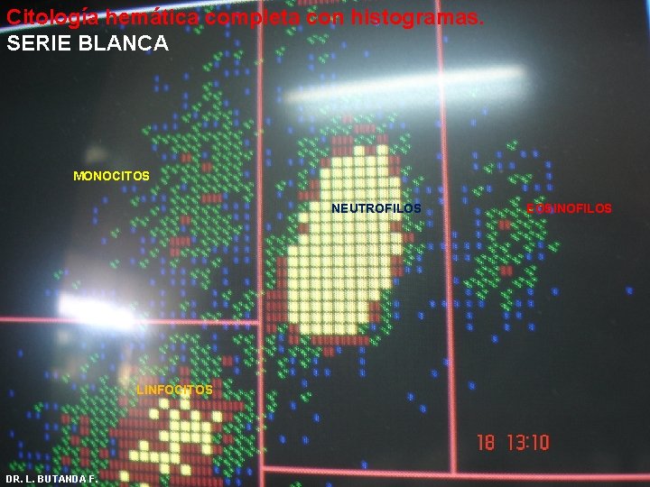 Citología hemática completa con histogramas. SERIE BLANCA MONOCITOS NEUTROFILOS LINFOCITOS DR. L. BUTANDA F. Citología hemática completa con histogramas. SERIE BLANCA MONOCITOS NEUTROFILOS LINFOCITOS DR. L. BUTANDA F.