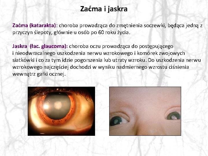 Zaćma i jaskra Zaćma (katarakta): choroba prowadząca do zmętnienia soczewki, będąca jedną z przyczyn