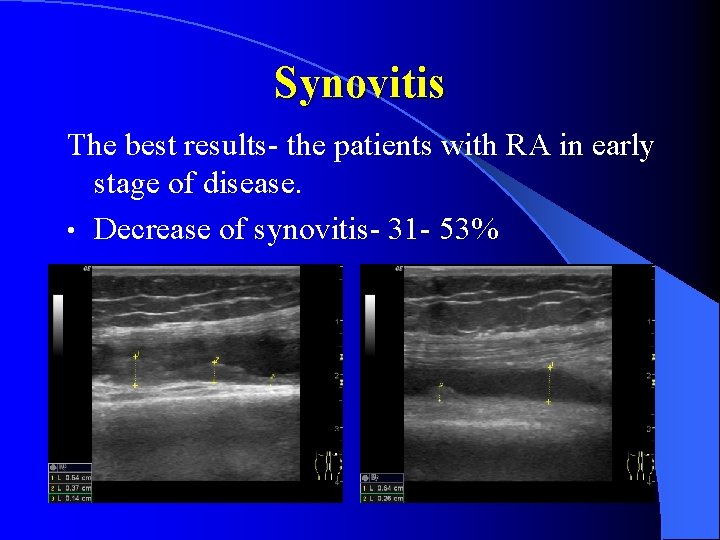 Synovitis The best results- the patients with RA in early stage of disease. •