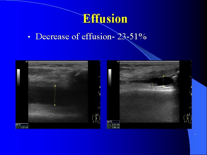 Effusion • Decrease of effusion- 23 -51% . 