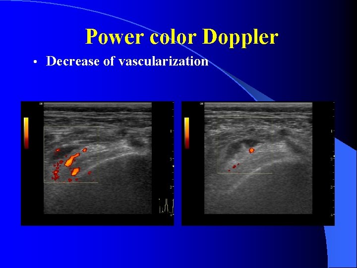 Power color Doppler • Decrease of vascularization 