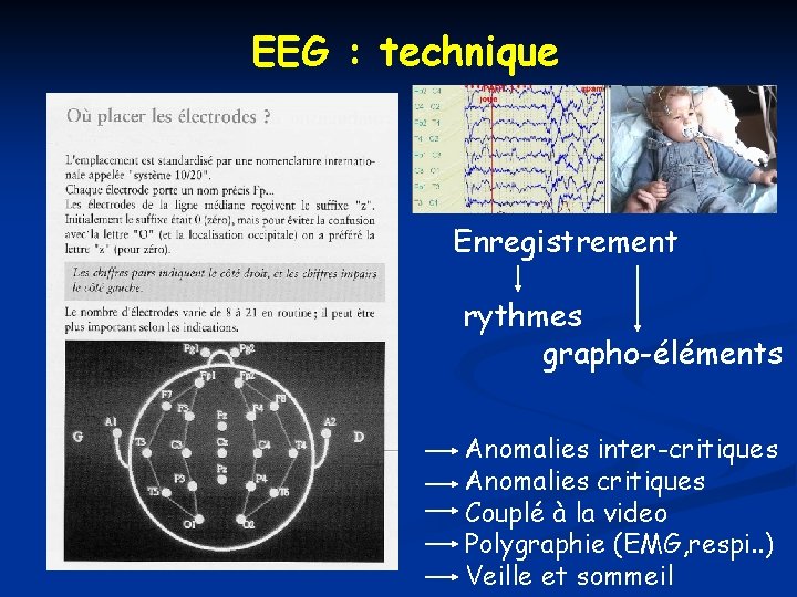 EEG : technique Enregistrement rythmes grapho-éléments Anomalies inter-critiques Anomalies critiques Couplé à la video