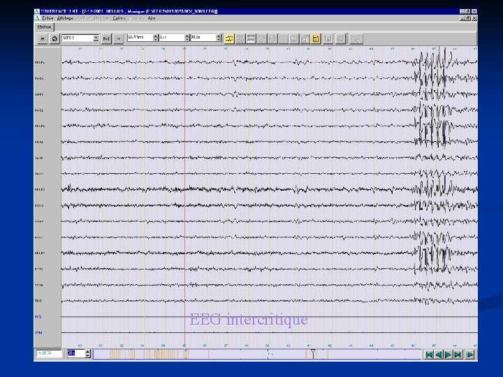 EEG intercritique 