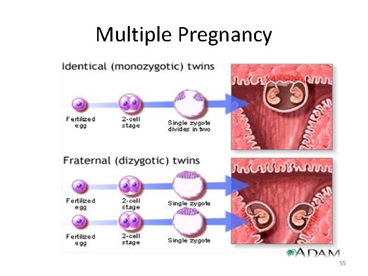 Multiple Pregnancy 55 