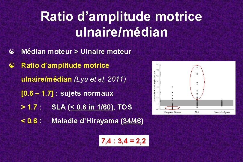 Ratio d’amplitude motrice ulnaire/médian ☯ Médian moteur > Ulnaire moteur ☯ Ratio d’amplitude motrice