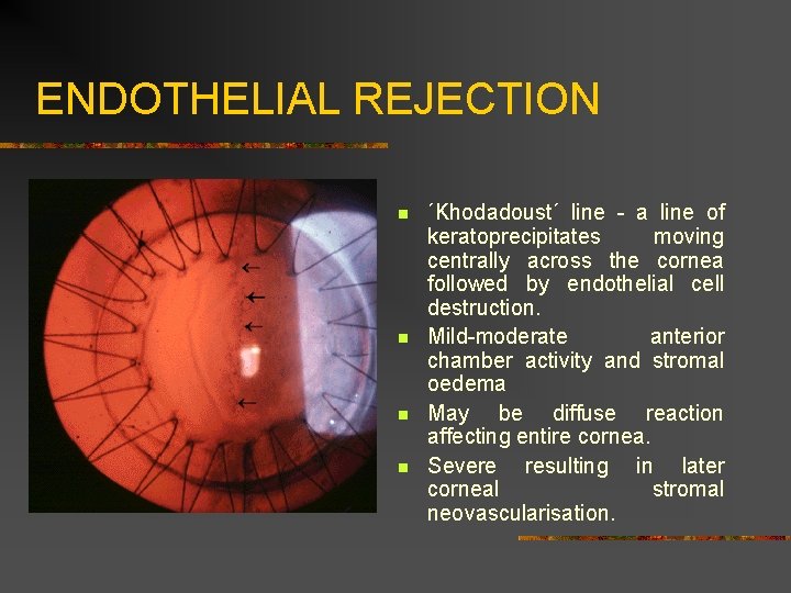 ENDOTHELIAL REJECTION n n ´Khodadoust´ line - a line of keratoprecipitates moving centrally across