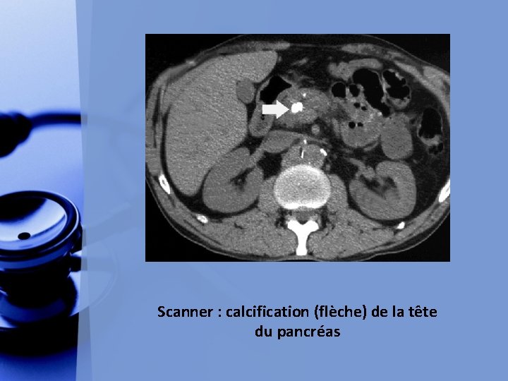 Scanner : calcification (flèche) de la tête du pancréas 