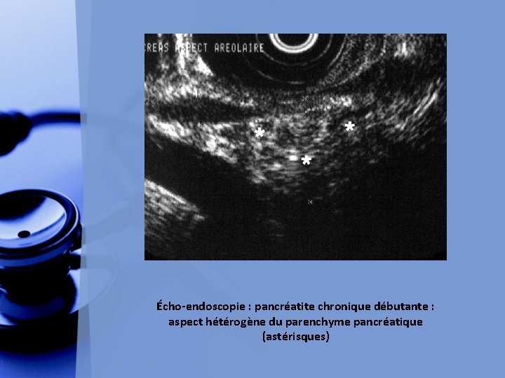 Écho-endoscopie : pancréatite chronique débutante : aspect hétérogène du parenchyme pancréatique (astérisques) 