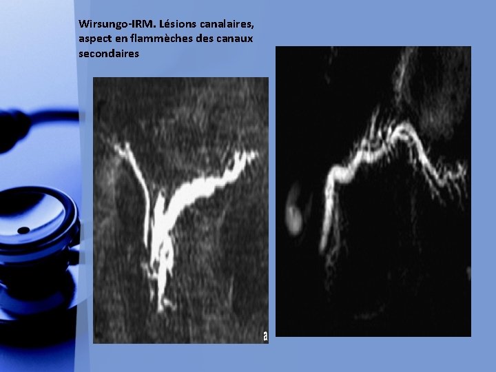 Wirsungo-IRM. Lésions canalaires, aspect en flammèches des canaux secondaires 