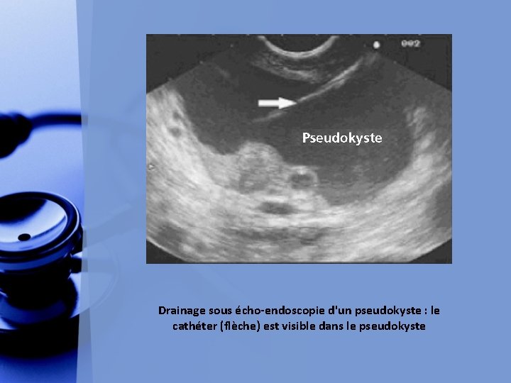 Drainage sous écho-endoscopie d'un pseudokyste : le cathéter (flèche) est visible dans le pseudokyste