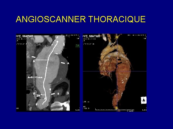 ANGIOSCANNER THORACIQUE 