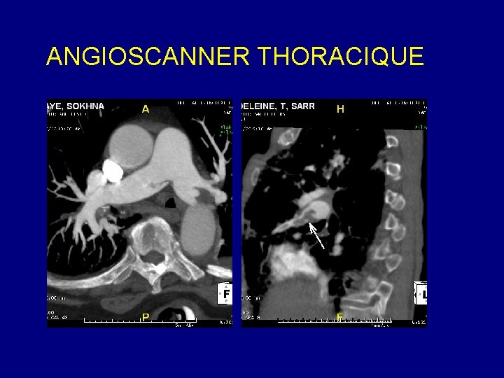 ANGIOSCANNER THORACIQUE 