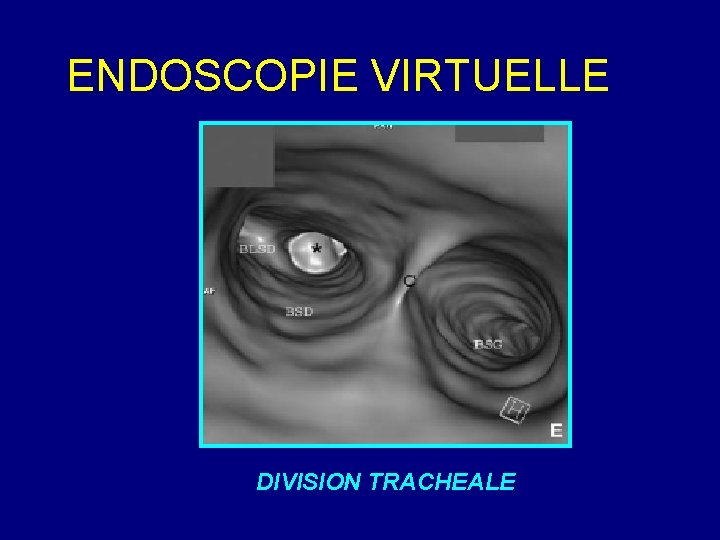 ENDOSCOPIE VIRTUELLE DIVISION TRACHEALE 