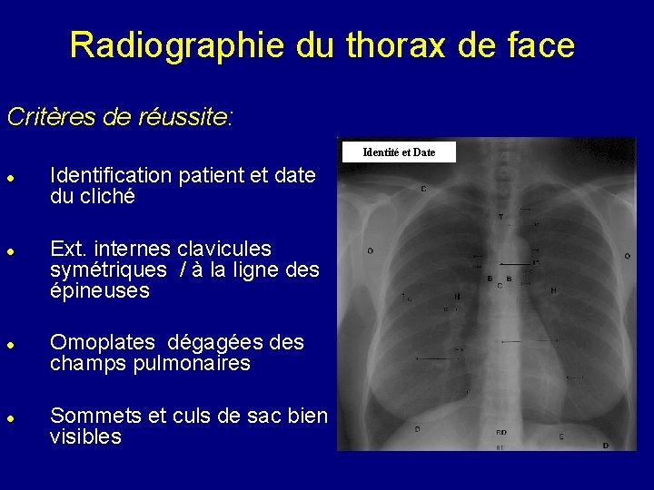 Radiographie du thorax de face Critères de réussite: Identité et Date Identification patient et