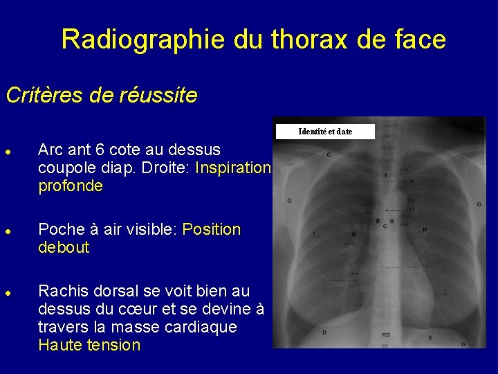 Radiographie du thorax de face Critères de réussite Identité et date Arc ant 6