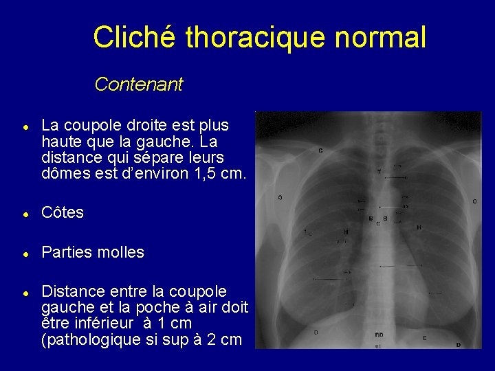 Cliché thoracique normal Contenant La coupole droite est plus haute que la gauche. La