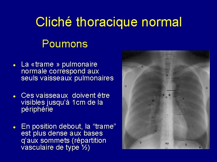 Cliché thoracique normal Poumons La «trame » pulmonaire normale correspond aux seuls vaisseaux pulmonaires
