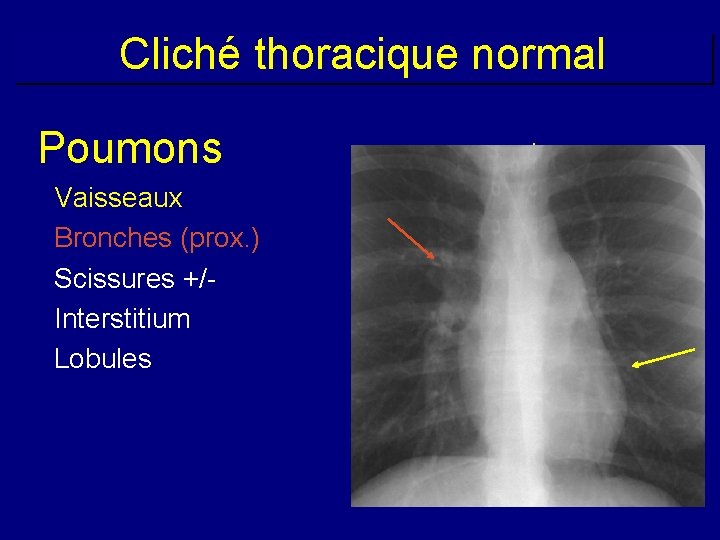 Cliché thoracique normal Poumons Vaisseaux Bronches (prox. ) Scissures +/Interstitium Lobules les 