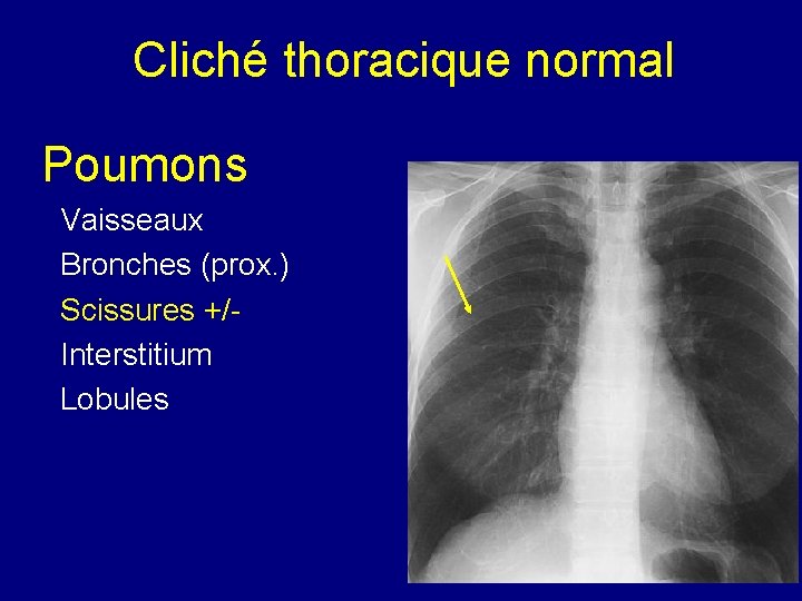 Cliché thoracique normal Poumons Vaisseaux Bronches (prox. ) Scissures +/Interstitium Lobules 